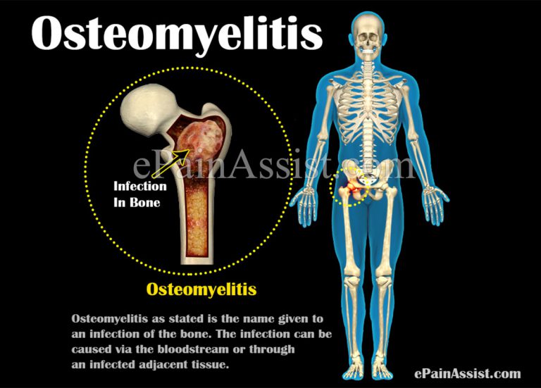 Osteomyelitis: Causes, Risk Factors, Symptoms, Diagnosis, Treatment, Prevention