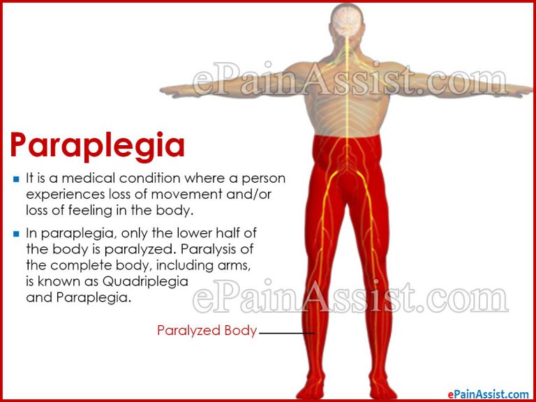 Paraplegia: Causes, Symptoms, Tests, Treatment- Surgery, PT, Rehab
