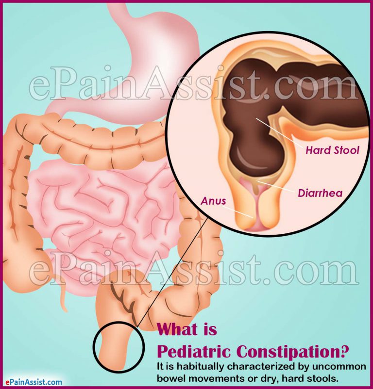 Pediatric Constipation: Facts, Causes, Diagnosis