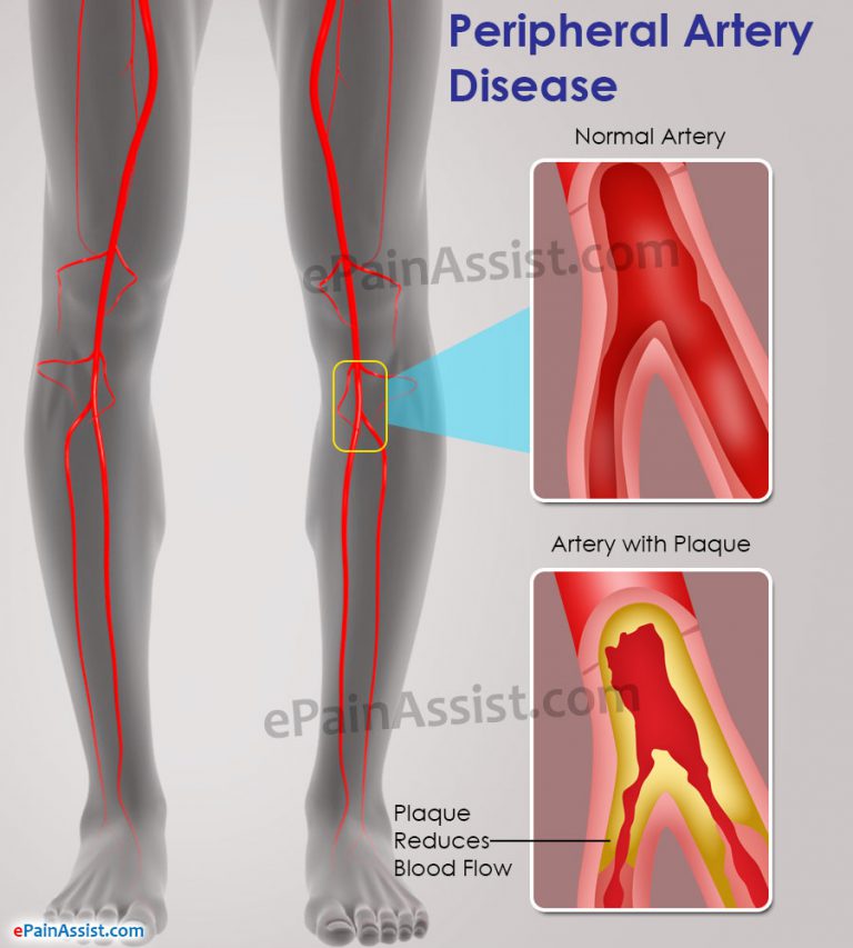 Peripheral Artery Disease: Causes, Symptoms, Treatment, Do’s & Don’ts