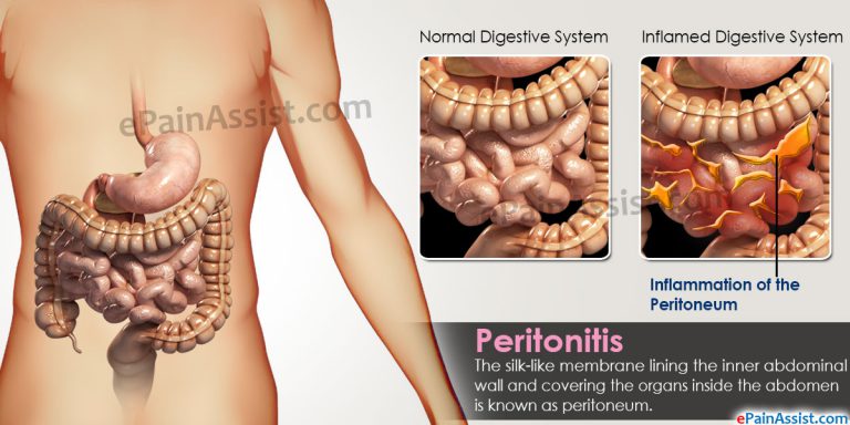 What Causes Peritonitis and What Is Its Treatment?