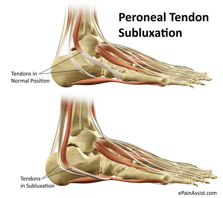Peroneal Tendon Subluxation or Dislocation: Causes, Symptoms, Treatment, Recovery, Exercises