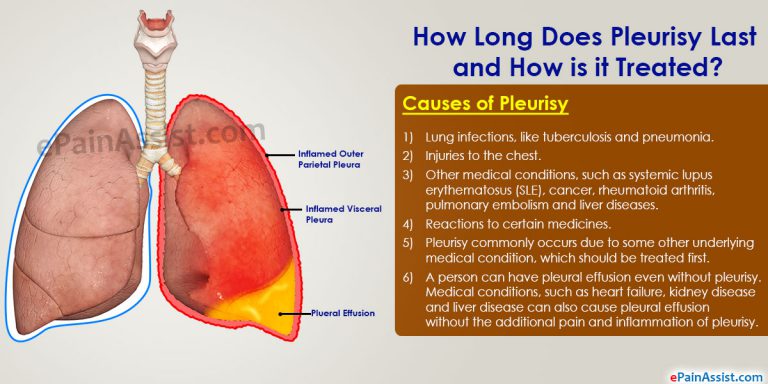 How Long Does Pleurisy Last and How Is It Treated?