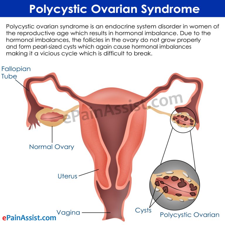 What Causes Infertility in Women with Polycystic Ovarian Syndrome?
