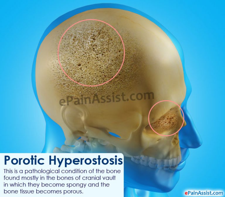 Porotic Hyperostosis: Causes, Symptoms, Diagnosis, Treatment