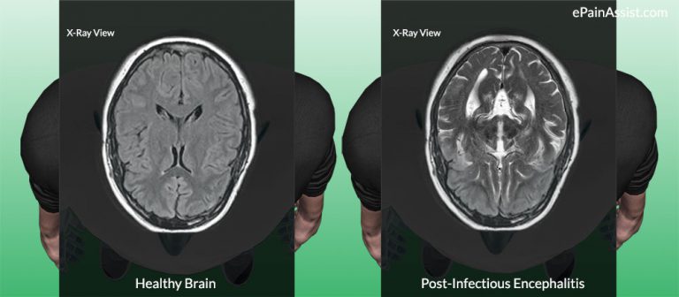 Post-Infectious Encephalitis: Causes, Symptoms, Diagnosis, Treatment- Intravenous Steroids