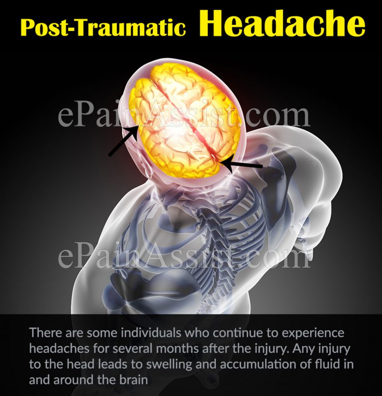 Post-Traumatic Headache: Causes, Symptoms, Treatment, Lifestyle Modifications
