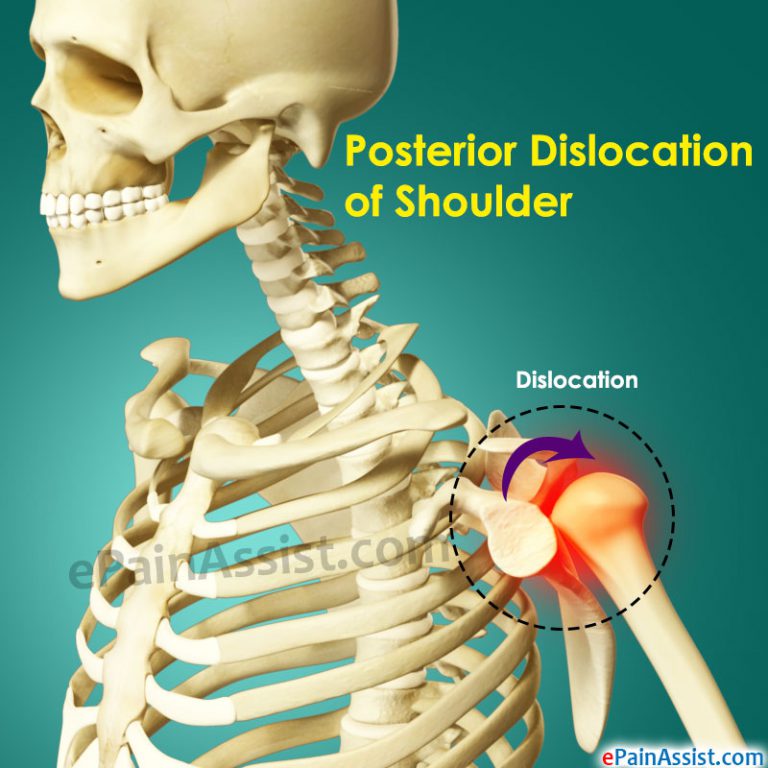 Posterior Dislocation Of Shoulder: Causes, Symptoms, Diagnosis, Treatment