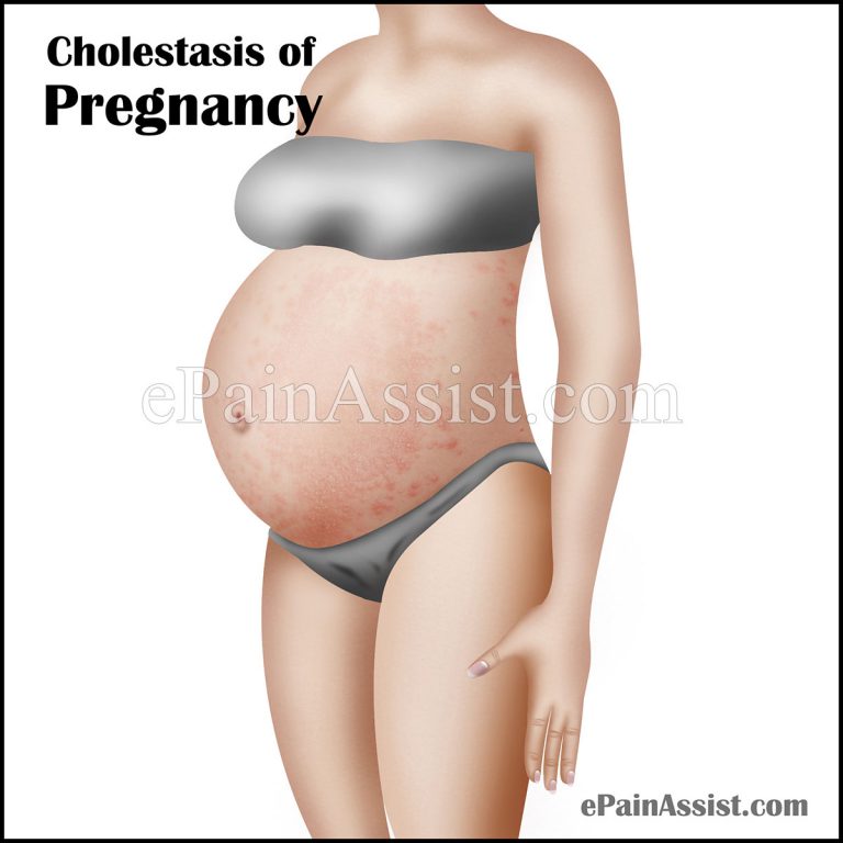What is Cholestasis of Pregnancy or Obstetric Cholestasis?