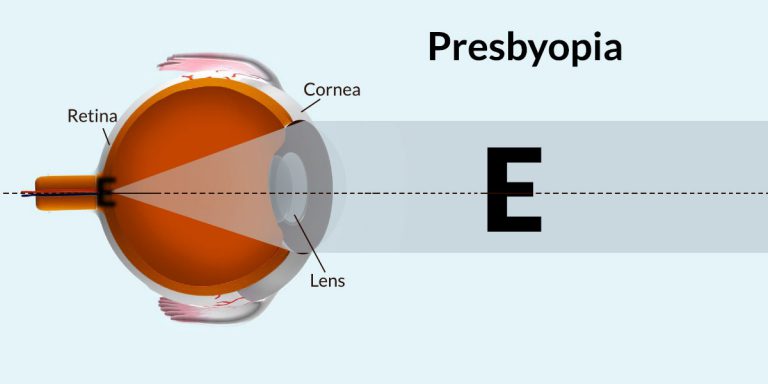 Presbyopia : Causes, Signs, Treatment- Refractive Surgery, Lifestyle Changes