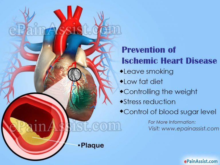 Ischemic Heart Disease: Prognosis, Recovery Period, Prevention, Yoga Poses