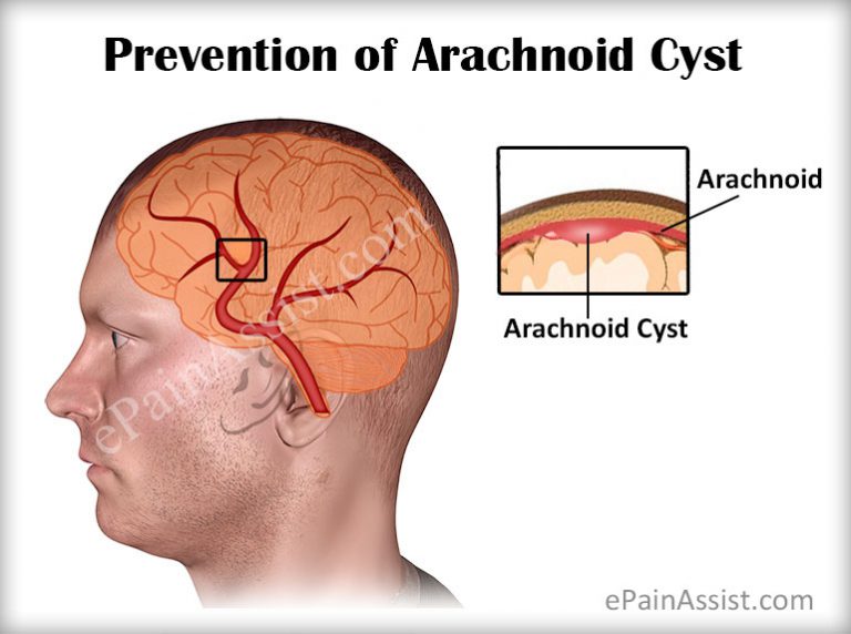 Arachnoid Cyst: Prevention, Prognosis, Coping Tips
