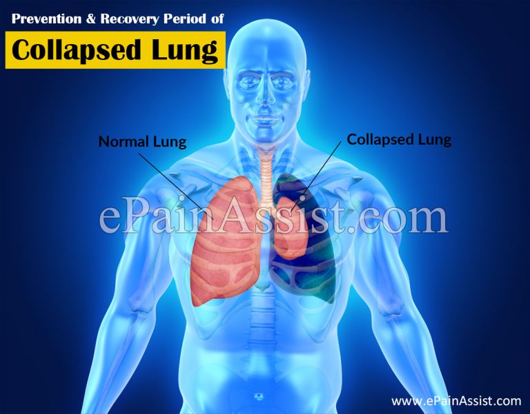 Prevention & Recovery Period of Collapsed Lung or Pneumothorax