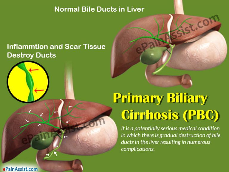 Primary Biliary Cirrhosis (PBC): Definition, Causes, Risk Factors, Symptoms, Diagnosis, Treatment, Complications, Home Remedies