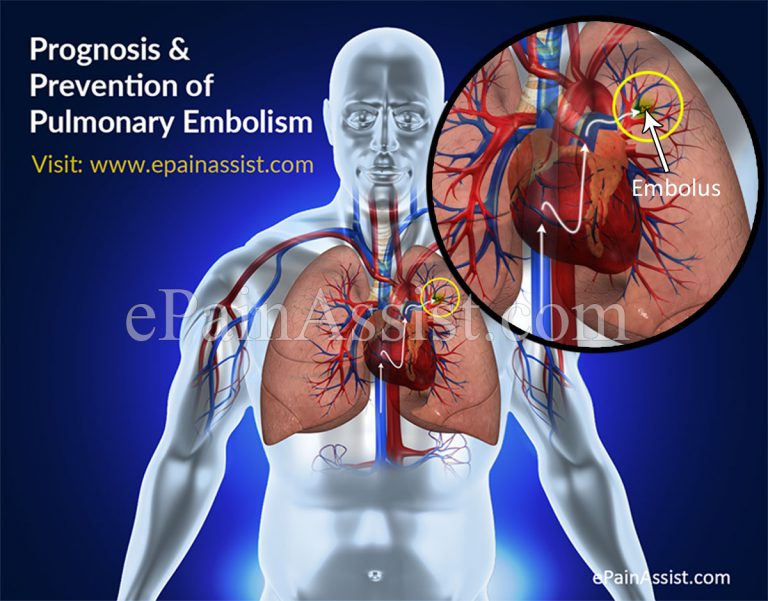 Prognosis & Prevention of Pulmonary Embolism