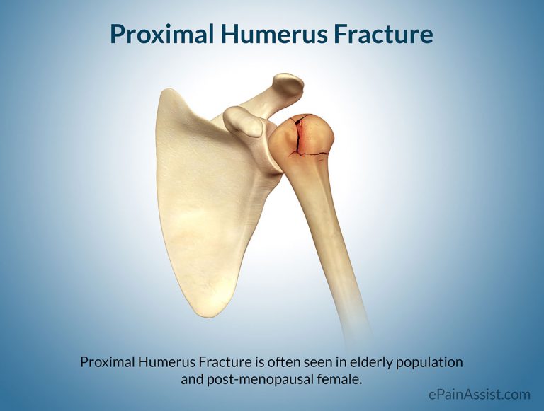 Proximal Humerus Fracture: Classification, Causes, Symptoms, Treatment, Exercises