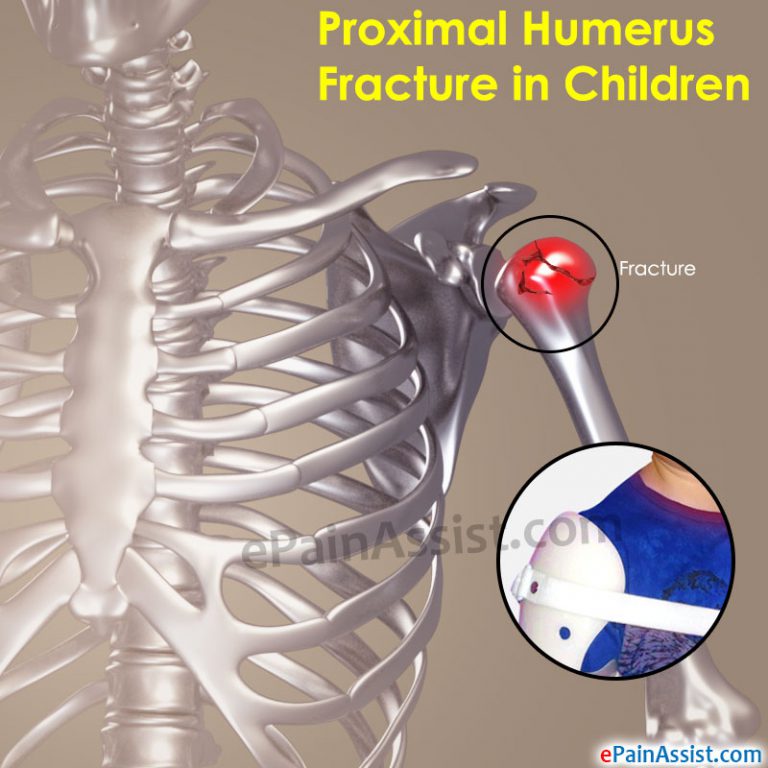 Proximal Humerus Fracture in Children: Causes, Symptoms, Treatment & Complications
