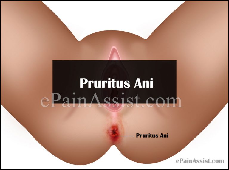 Pruritus Ani or Itching in Anus: Causes, Symptoms, Treatment, Home Remedies
