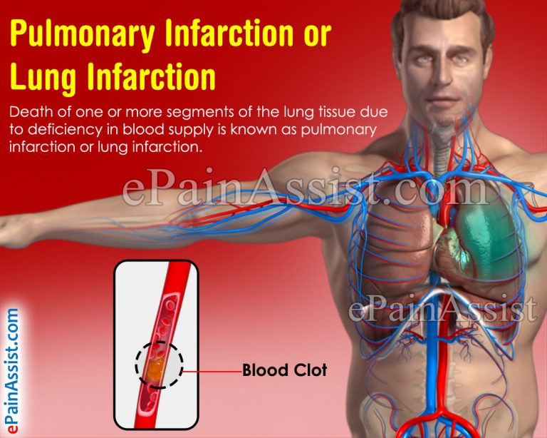 Pulmonary Infarction or Lung Infarction: Causes, Symptoms, Signs, Tests, Treatment
