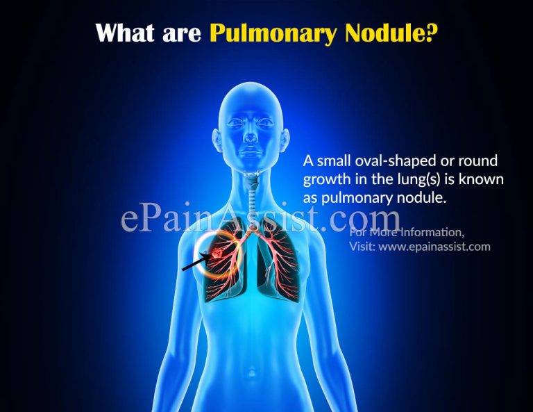 Pulmonary Nodule: Causes, Symptoms, Treatment, Diagnosis