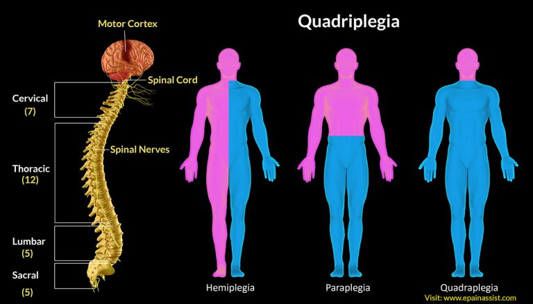 Quadriplegia: Causes, Symptoms, Treatment, Complications|Can Quadriplegics Live A Normal Life?