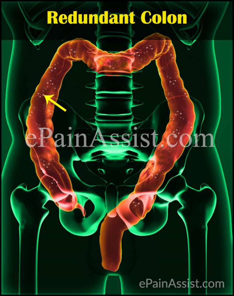 Redundant Colon: Symptoms, Treatments, Causes, Diet