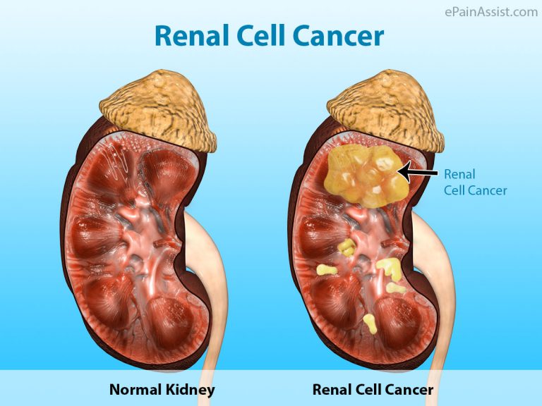 Renal Cell Cancer or Hypernephroma: Causes, Symptoms, Treatment, Diagnosis, Prognosis, Complications