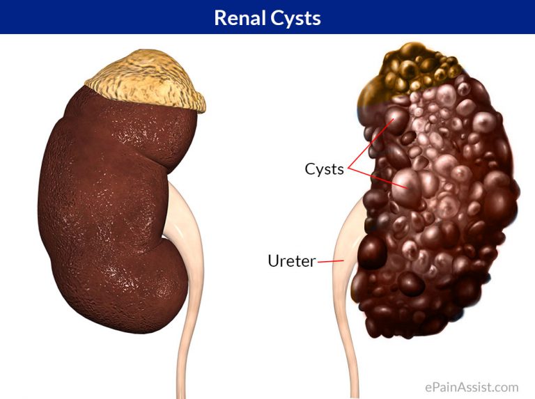 Renal Cysts: Causes, Risk Factors, Symptoms, Diagnosis, Treatment, Complications