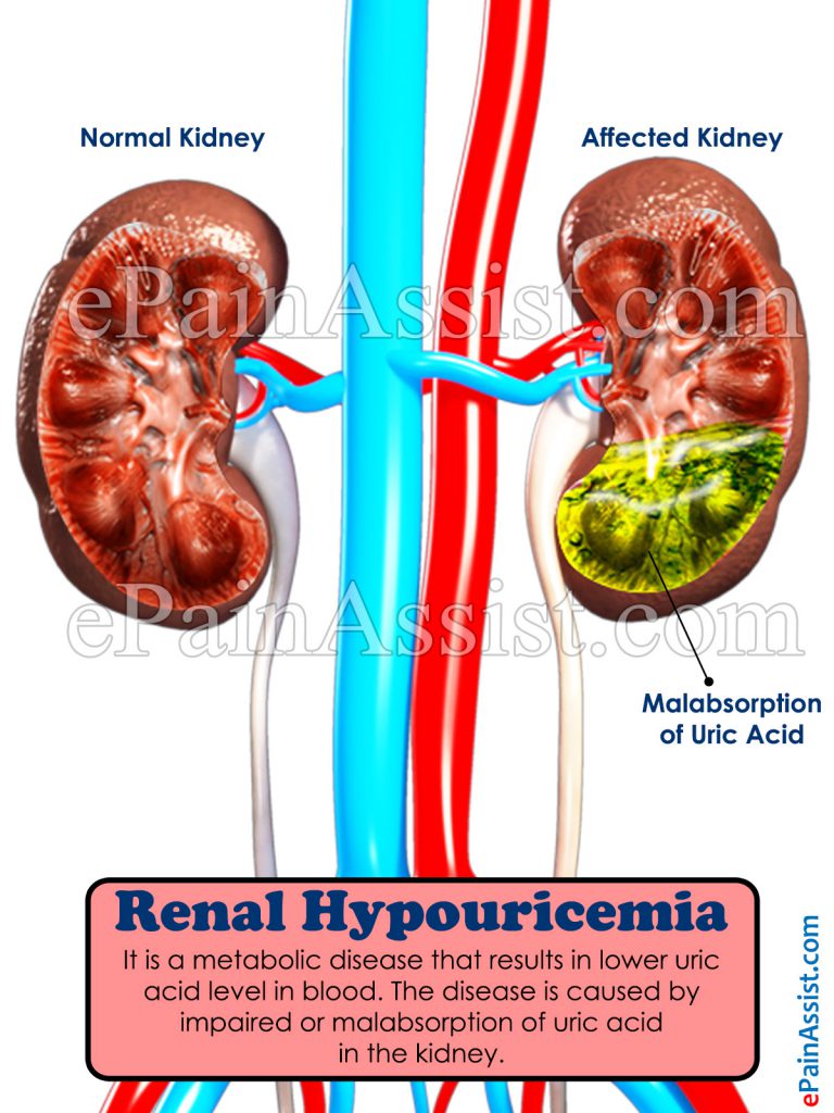 Renal Hypouricemia: Causes, Risk Factors, Symptoms, Diagnosis, Treatment, Prognosis, Complications