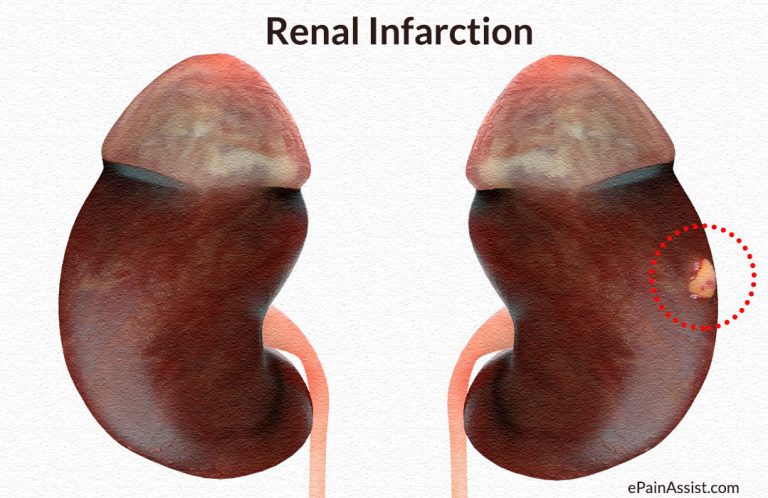 Renal Infarction: Causes, Symptoms, Signs, Diagnosis, Treatment