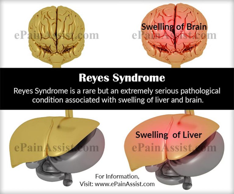 Reyes (Reye) Syndrome: Causes, Symptoms, Treatment, Risk Factors, Complications