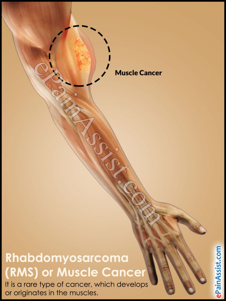Rhabdomyosarcoma (RMS) or Muscle Cancer: Types, Causes, Symptoms, Treatment- Surgery