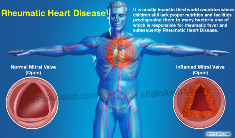Rheumatic Heart Disease: Symptoms, Treatment, Facts, Prevention