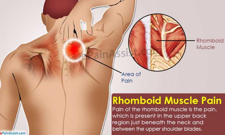 Rhomboid Muscle Pain: Causes, Symptoms, Treatment, Exercises, Prevention