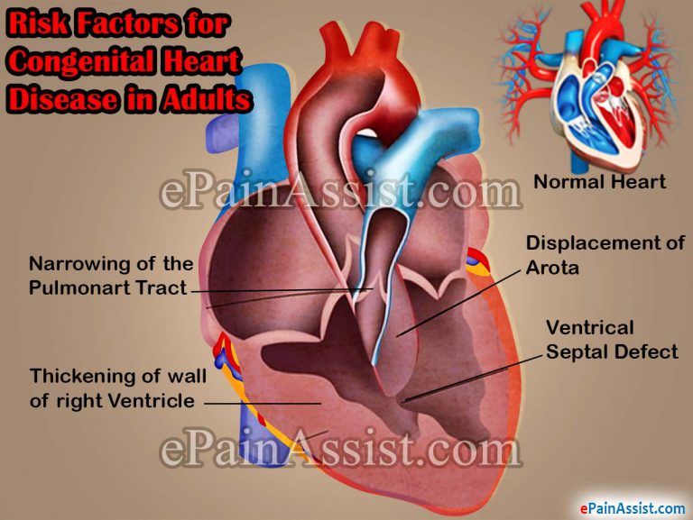 Congenital Heart Disease in Adults: Risk Factors, Complications, Diagnosis