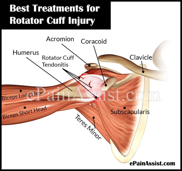 Rotator Cuff Injury: Best Treatments and Recovery Note