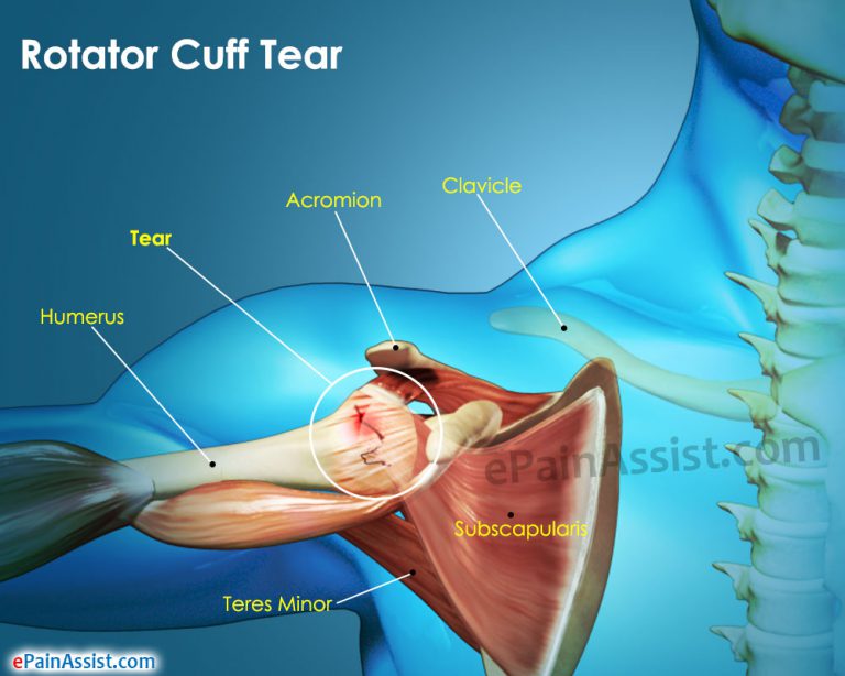 Rotator Cuff Tear: Types, Causes, Risk Factors, Symptoms, Diagnosis, Treatment, Recovery, Rehabilitation, Complications