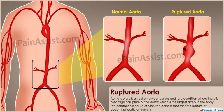 Ruptured Aorta: Symptoms, Causes, Treatment, Prognosis, Prevention