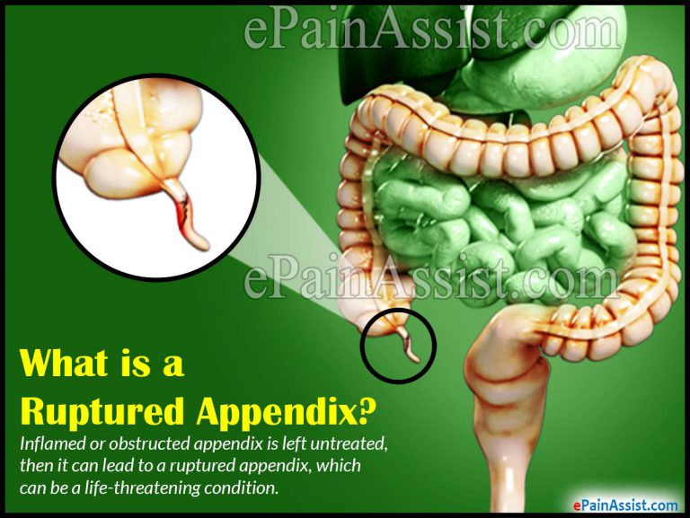 Ruptured Appendix: Causes, Symptoms, Treatment, Signs, Complications