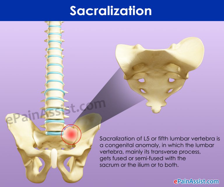 What Is Sacralization And How Is It Treated?