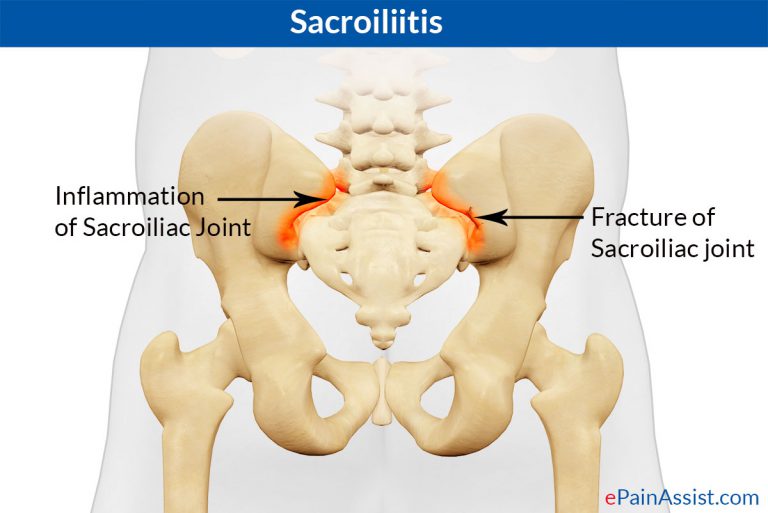 Sacroiliitis: Causes, Symptoms, Treatment- Medications, Sacroiliac Joint Injections