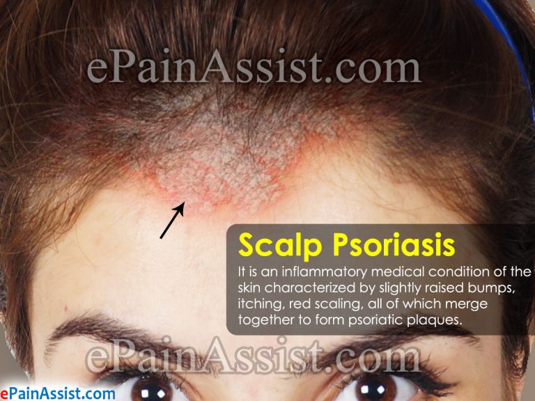 Scalp Psoriasis: Causes, Symptoms, Treatment, Prognosis, Home Remedies