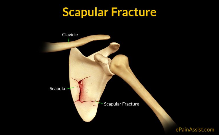 Scapular Fracture or Broken Shoulder Blade: Causes, Symptoms, Diagnosis, Treatment, Exercise