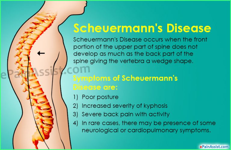 Scheuermann’s Disease or Scheuermann’s Kyphosis: Causes, Symptoms, Treatment, Prognosis, Diagnosis, Complications