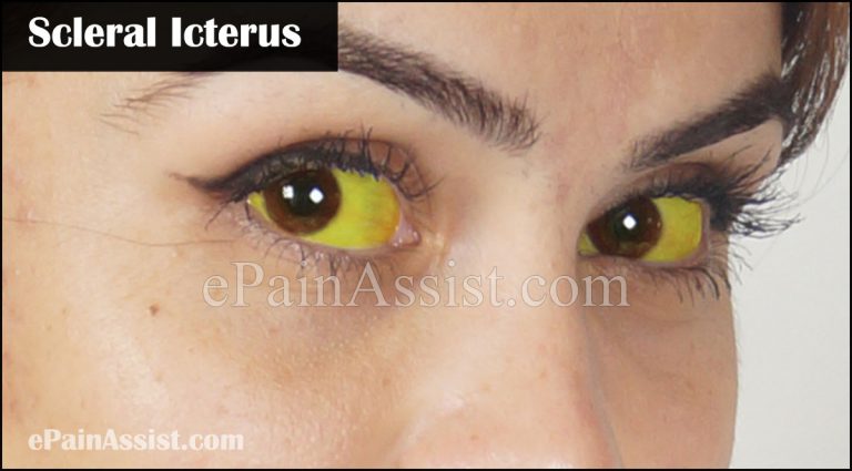 Medical Conditions that Cause Scleral Icterus & its Treatment!