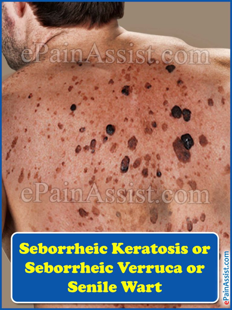 Seborrheic Keratosis or Seborrheic Verruca or Senile Wart: Causes, Symptoms, Treatment