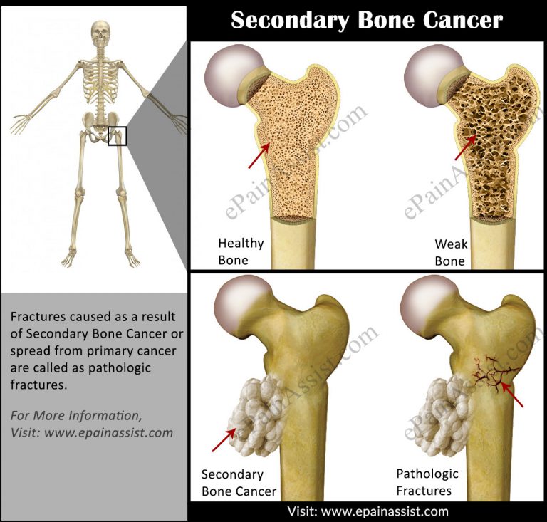 Secondary Bone Cancer: A Cause For Pathologic Fracture