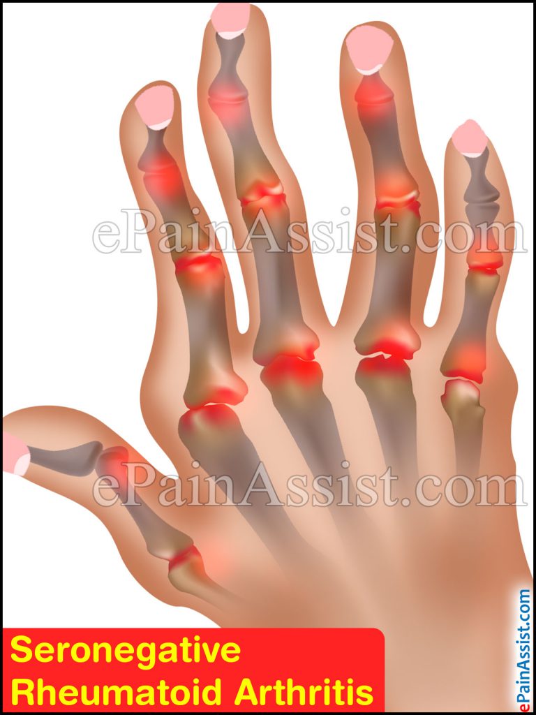 Seronegative Rheumatoid Arthritis: Symptoms, Treatment, Diagnosis