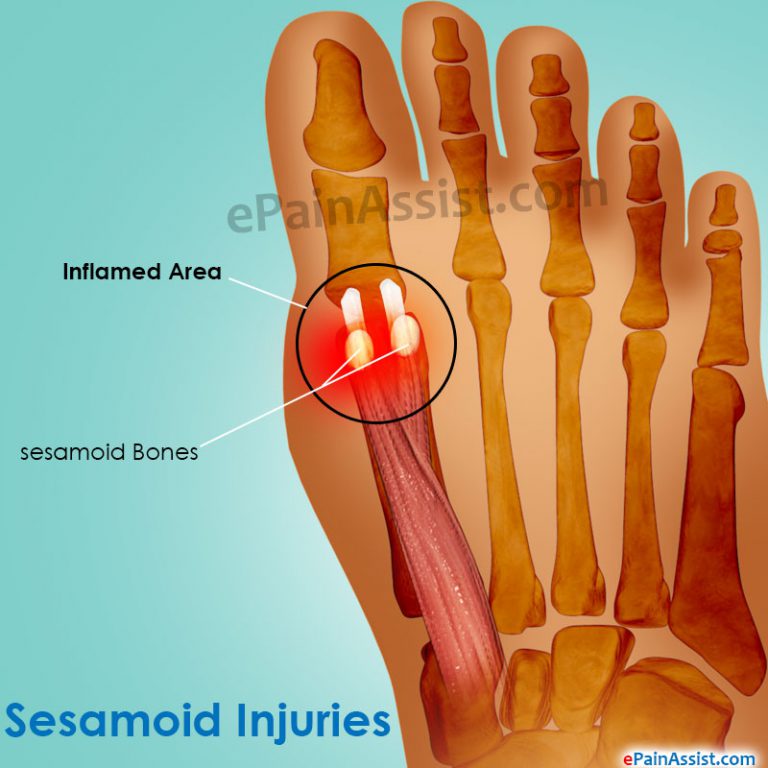 Sesamoid Injuries: Signs, Symptoms, Treatment, Recovery, Prevention