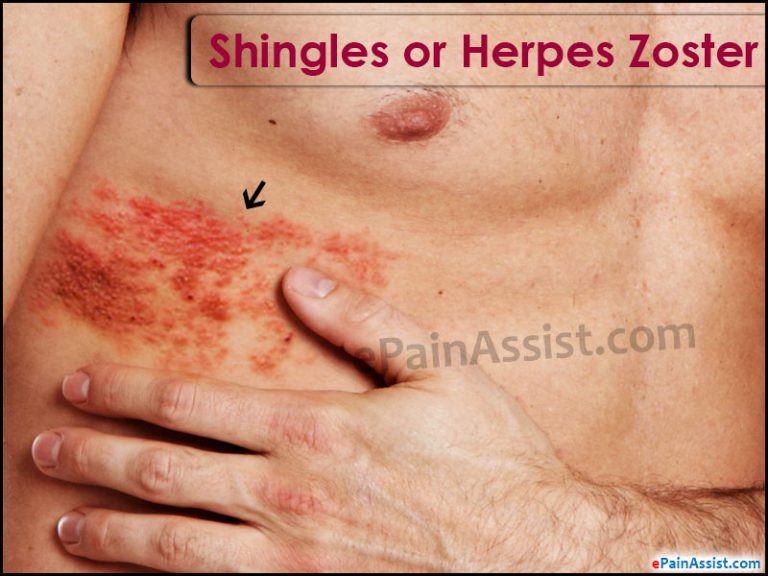 Shingles or Herpes Zoster: Causes, Symptoms, Treatment- Antivirals, Calamine Lotion
